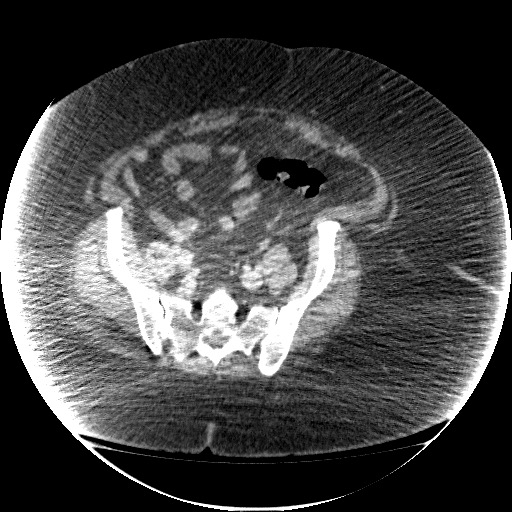 File:Collection due to leak after sleeve gastrectomy (Radiopaedia 55504-61972 A 62).jpg