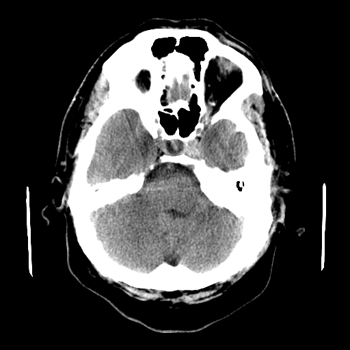 File:Colloid cyst with anterior communicating artery aneurysm (Radiopaedia 33901-35090 Axial non-contrast 5).jpg