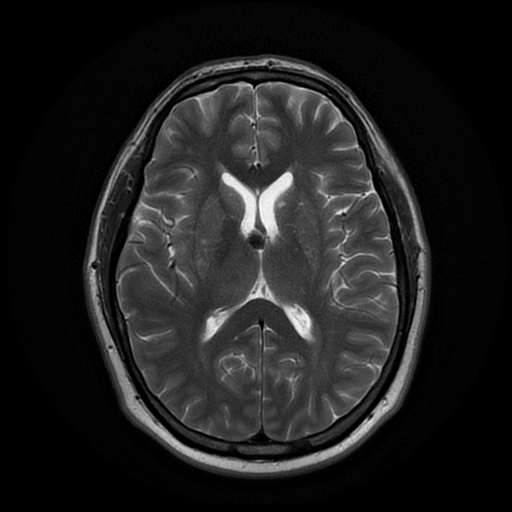 File:Colloid cyst with anterior communicating artery aneurysm (Radiopaedia 33901-35091 Axial T2 14).jpg