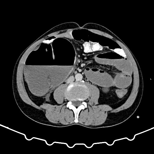 File:Colocolic intussusception due to large lipoma (Radiopaedia 68773-78482 A 100).jpg