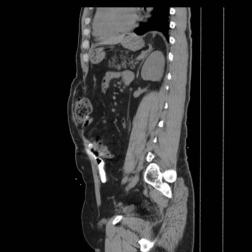Colocutaneous fistula in Crohn's disease (Radiopaedia 29586-30093 F 28).jpg