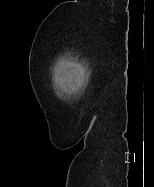 Colon adenocarcinoma (Radiopaedia 59374-66735 C 6).jpg