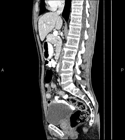 Colon adenocarcinoma - hepatic flexure (Radiopaedia 85635-101395 D 42).jpg
