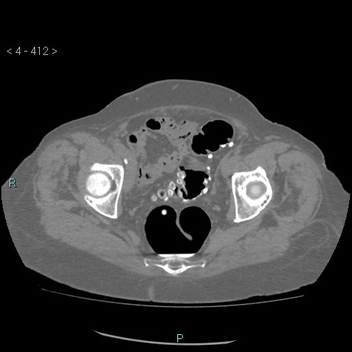 File:Colonic lipomas (Radiopaedia 49137-54244 Axial bone window 184).jpg