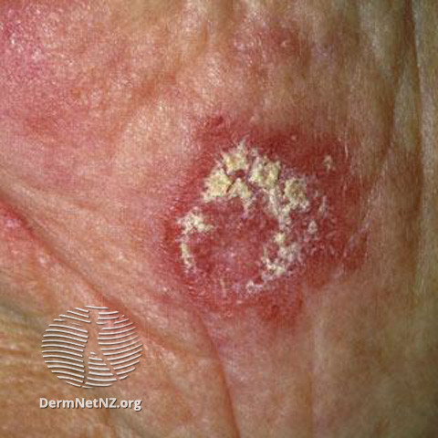 Cutaneous lupus erythematosus (DermNet NZ immune-lupus-erythematosus-2519).jpg