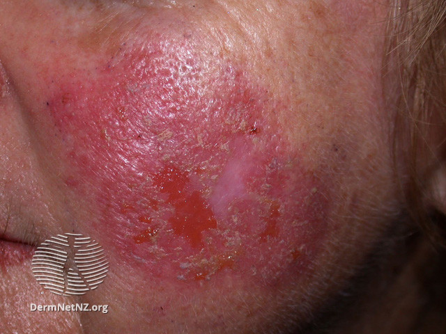 Intraepidermal carcinoma (DermNet NZ lesions-scc-in-situ-2935).jpg