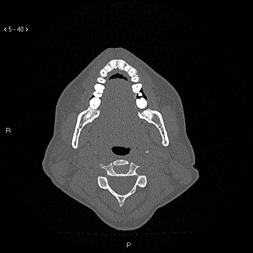 File:Nasolabial cyst (Radiopaedia 75125-86194 Axial bone window 1).jpg