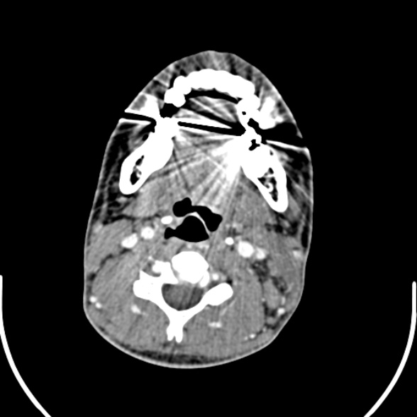 Nasopharyngeal carcinoma with skull base invasion (Radiopaedia 53415-59705 A 114).jpg