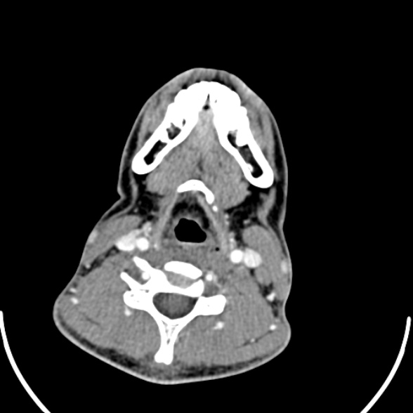 File:Nasopharyngeal carcinoma with skull base invasion (Radiopaedia 53415-59705 A 136).jpg