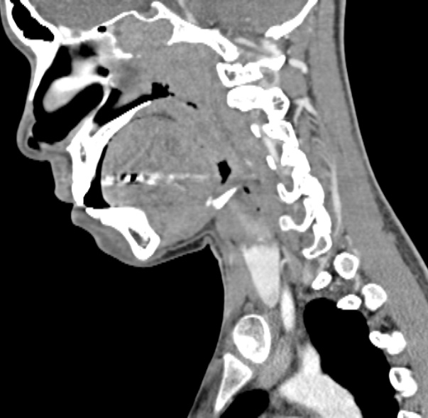 Nasopharyngeal carcinoma with skull base invasion (Radiopaedia 53415-59705 C 41).jpg
