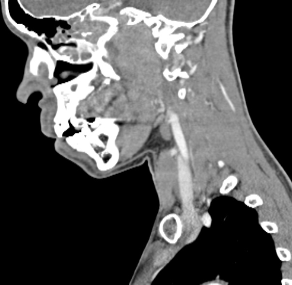 Nasopharyngeal carcinoma with skull base invasion (Radiopaedia 53415-59705 C 46).jpg