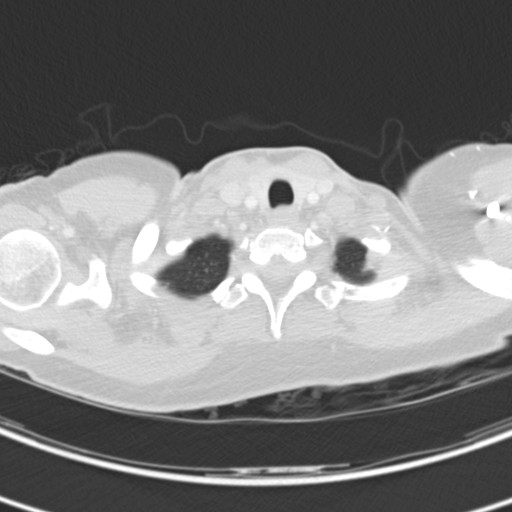 Necrobiotic pulmonary nodules - Crohn disease (Radiopaedia 20723-20631 Axial lung window 10).jpg