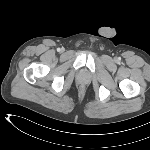 File:Necrotizing pancreatitis with acute necrotic collections (Radiopaedia 38829-41012 B 88).png