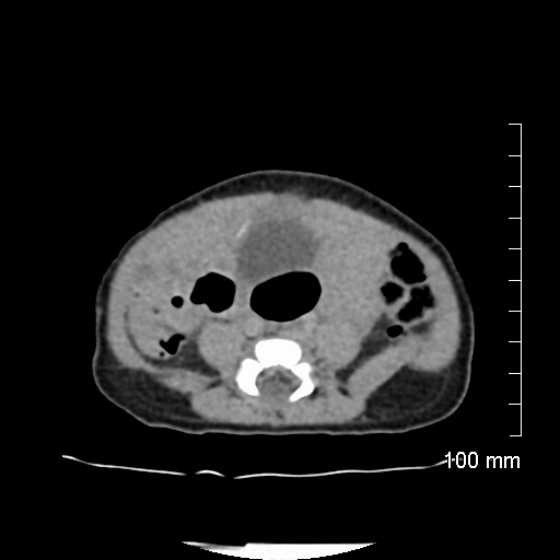File:Neonatal neuroblastoma (Radiopaedia 56651-63438 Axial non-contrast 56).jpg