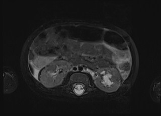Neonatal prostatic utricle abscess - cyst (Radiopaedia 69511-79394 Axial T2 fat sat 45).jpg