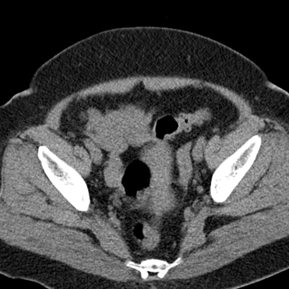 File:Nephrostomy for urosepsis (Radiopaedia 26180-26330 Axial non-contrast 57).jpg