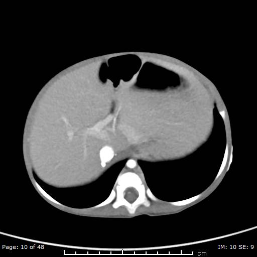 File:Neuroblastoma (Radiopaedia 41472-44355 A 10).jpg