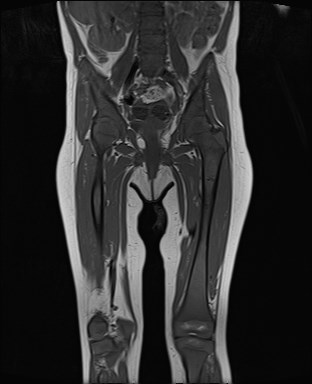 File:Neuroblastoma with bone metastases (Radiopaedia 67080-76414 Coronal T1 12).jpg