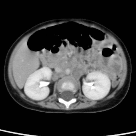 Neuroblastoma with skull metastases (Radiopaedia 30326-30960 C 29).jpg