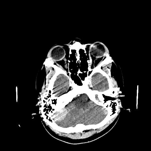 File:Neurofibromatosis type 2 (Radiopaedia 25389-25637 Axial C+ 13).jpg