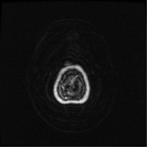 Neurofibromatosis type 2 (Radiopaedia 45229-49244 Axial T1 C+ 114).png