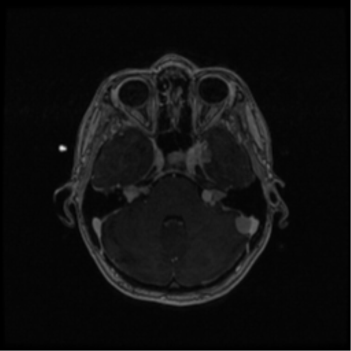 Neurofibromatosis type 2 (Radiopaedia 45229-49244 Axial T1 C+ 42).png