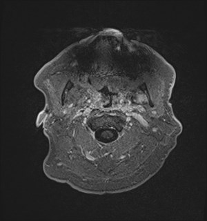 Neurofibromatosis type 2 (Radiopaedia 79097-92049 Axial T1 C+ 6).jpg