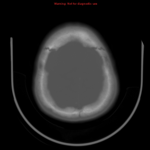 File:Neurofibromatosis type 2 (Radiopaedia 8953-9732 Axial bone window 28).jpg