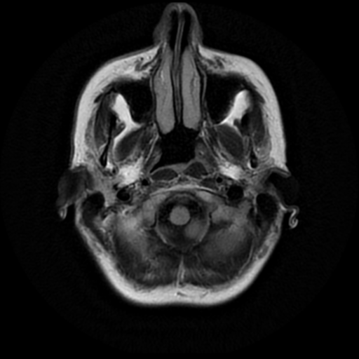 File:Neurofibromatosis type 2 - bilateral acoustic neuromata (Radiopaedia 40060-42566 Axial FLAIR 2).png