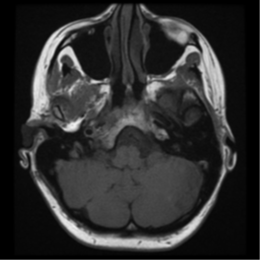 File:Neurofibromatosis type 2 - bilateral acoustic neuromata (Radiopaedia 40060-42566 Axial T1 5).png