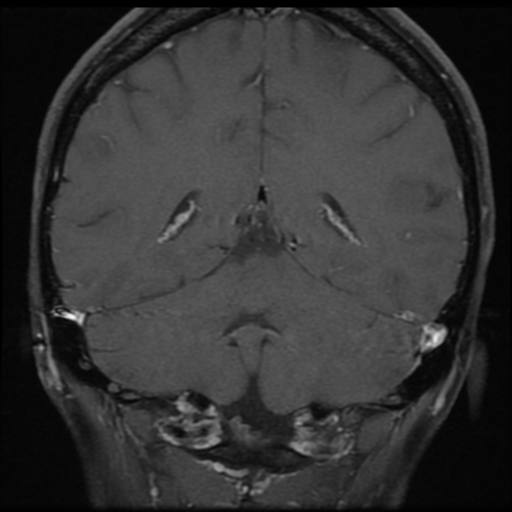 File:Neurofibromatosis type 2 - bilateral acoustic neuromata (Radiopaedia 40060-42566 Coronal T1 C+ 1).png