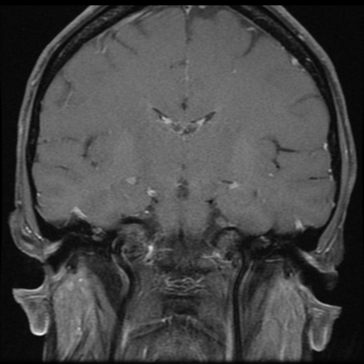 File:Neurofibromatosis type 2 - bilateral acoustic neuromata (Radiopaedia 40060-42566 Coronal T1 C+ 7).png