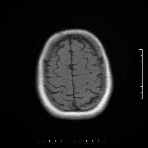 File:Neuroglial cyst of brainstem (Radiopaedia 29134-29526 Axial T1 18).jpg