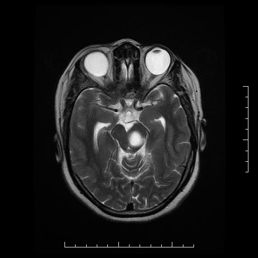 File:Neuroglial cyst of brainstem (Radiopaedia 29134-29526 Axial T2 8).jpg