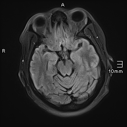 File:Neurotoxoplasmosis - concentric target sign (Radiopaedia 70644-80784 Axial FLAIR 8).jpg