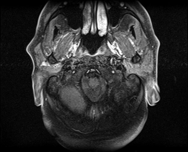 File:Non-Hodgkin lymphoma - parotid gland (Radiopaedia 71531-81890 Axial T1 C+ fat sat 18).jpg
