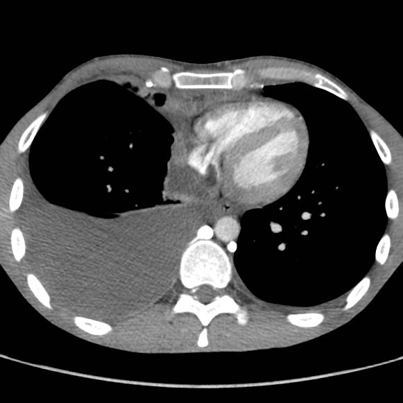 File:Non-Hodgkin lymphoma involving lung (Radiopaedia 29094-29470 B 46).jpg