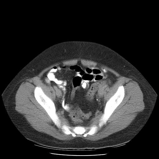 File:Non-Hodgkin lymphoma involving pelvis (Radiopaedia 21281-21197 B 52).jpg