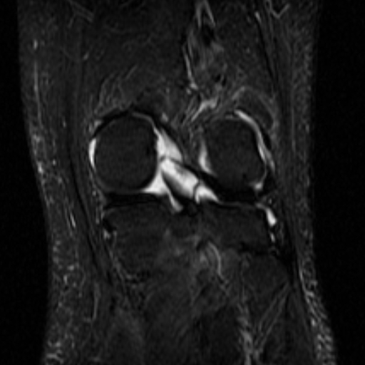 File:Non-displaced patella fracture (Radiopaedia 15932-15582 Coronal STIR 17).jpg