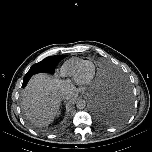 File:Non Hodgkin lymphoma in a patient with ankylosing spondylitis (Radiopaedia 84323-99621 Axial non-contrast 24).jpg
