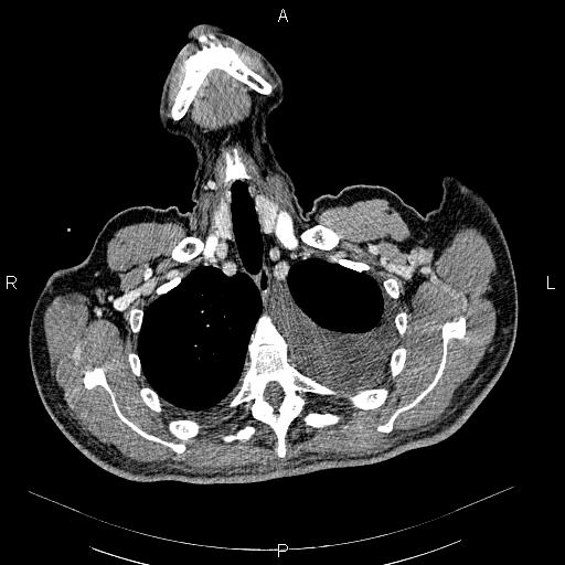 File:Non Hodgkin lymphoma in a patient with ankylosing spondylitis (Radiopaedia 84323-99621 B 7).jpg