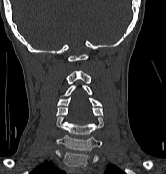 File:Normal CT cervical spine - 12-year-old (Radiopaedia 55352-61775 Coronal bone window 135).jpg