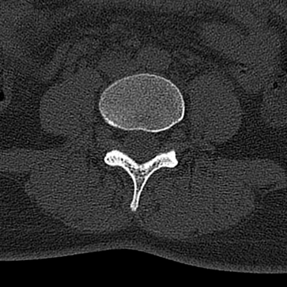 File:Normal CT lumbar spine (Radiopaedia 53981-60118 Axial bone window 49).jpg