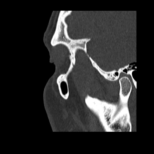 Normal CT paranasal sinuses (Radiopaedia 42286-45390 Sagittal bone window 95).jpg