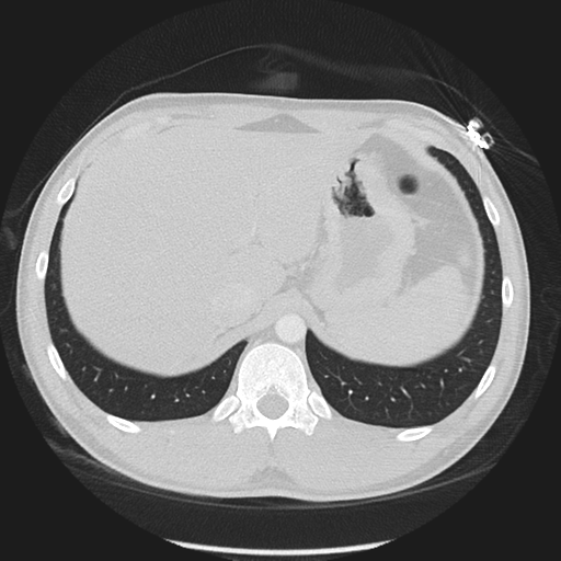 Normal CT pulmonary veins (pre RF ablation) (Radiopaedia 41748-44702 Axial lung window 66).png