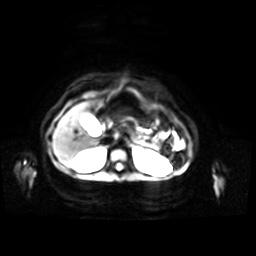 Normal MRI abdomen in pregnancy (Radiopaedia 88001-104541 Axial DWI 41).jpg