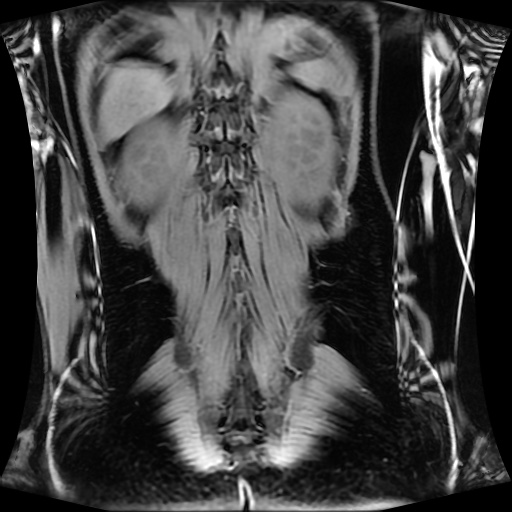 Normal MRI abdomen in pregnancy (Radiopaedia 88001-104541 M 115).jpg