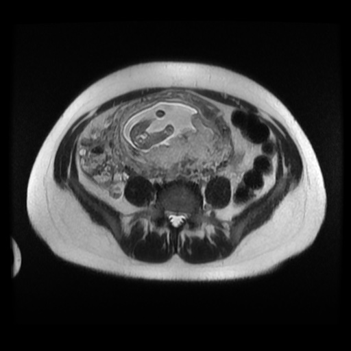 Normal MRI abdomen in pregnancy (Radiopaedia 88003-104546 Axial T2 27).jpg