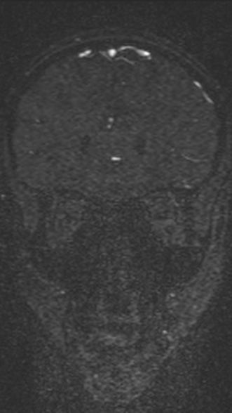 Normal MRI brain with MRV- teenager (Radiopaedia 49425-54553 Coronal MRV 83).jpg