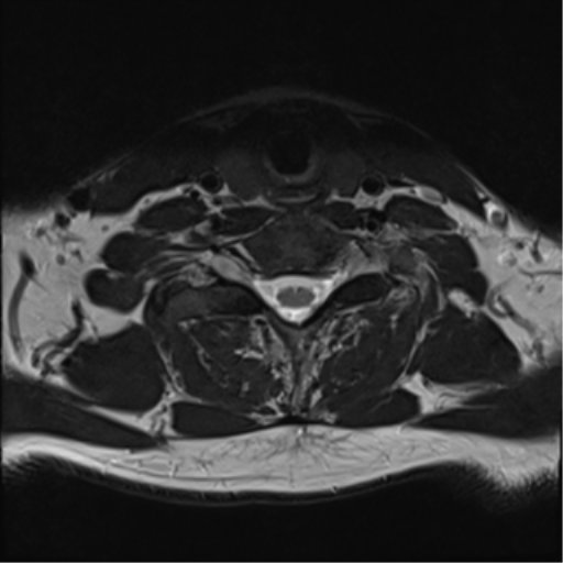 File:Normal MRI cervical spine (infection protocol) (Radiopaedia 53916-60039 Axial T2 38).png